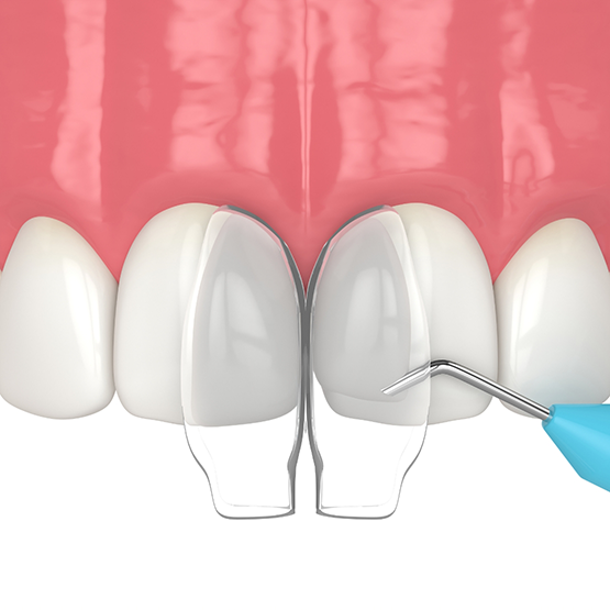 Illustration of dental bonding material being applied to a chipped tooth