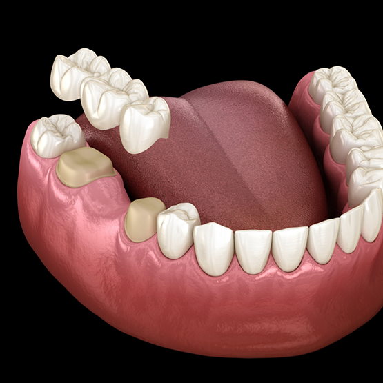 Illustration of a dental bridge being placed to replace a missing tooth