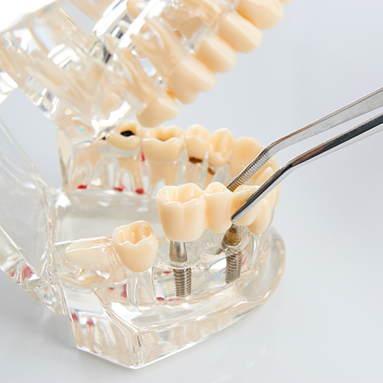 Tweezers placing a dental bridge in a model of the mouth