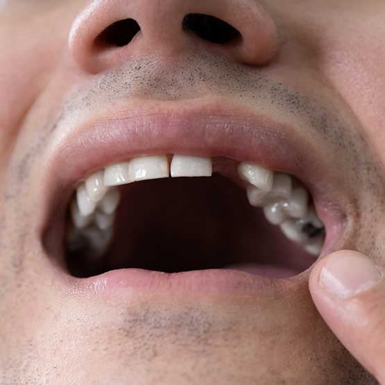 Close up of a man with one missing upper tooth pointing to his mouth