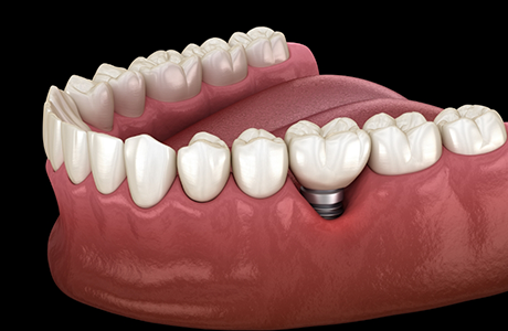 Illustration of a dental implant with a crown replacing one tooth
