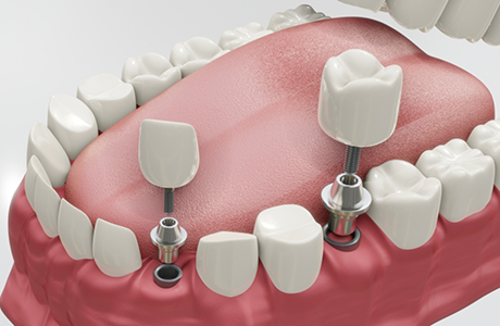 Illustration of two dental implants with crowns replacing two teeth