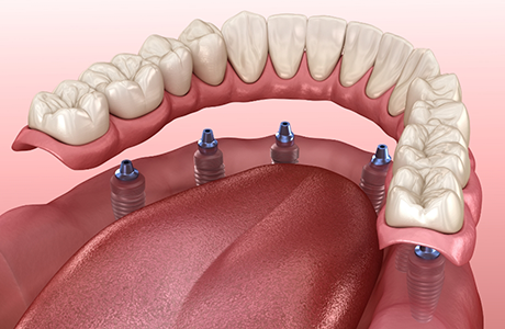 Illustration of six dental implants throughout the arch supporting a full denture