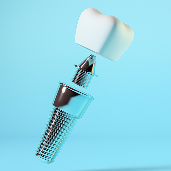 Illustration of a dental implant, a dental crown, and an abutment connector piece