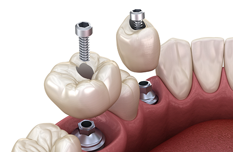 Illustration of two dental implants with dental crowns being placed in the lower arch