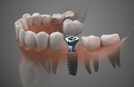 Illustration of a dental implant with a crown replacing a missing lower tooth