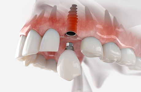 Illustration of a dental implant with a crown replacing a missing upper tooth