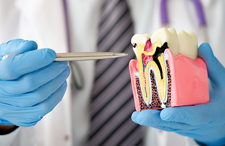 Dentist showing a patient a model of a decayed tooth in the gums