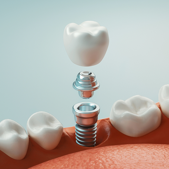 Illustration of a dental implant and a dental crown being placed in the lower jawbone