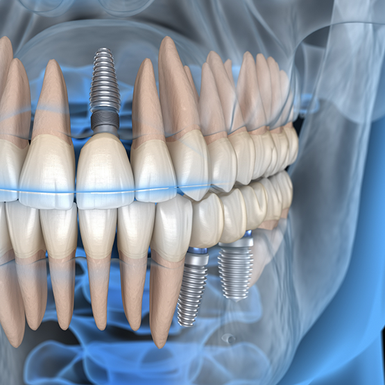Illustration of an x ray of a person with three dental implants