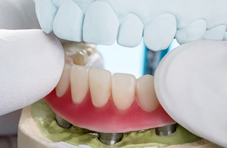 Dentist placing a denture over a model of the jaw with dental implants