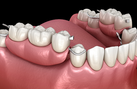 Illustration of a partial denture replacing several missing teeth along an arch