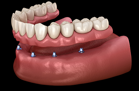 Illustration of a full denture being placed onto six dental implants