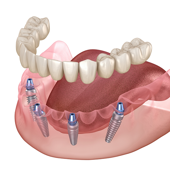 Illustration of a full denture being secured onto four dental implants along the lower arch
