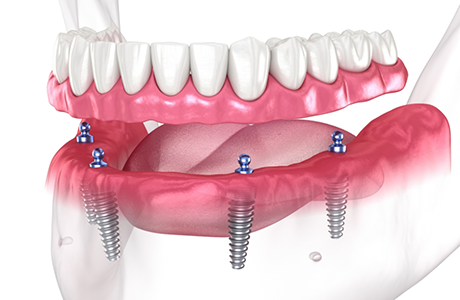 Illustration of a full denture being attached to four dental implants