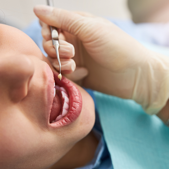 Dentist placing a white filling in a patient's tooth