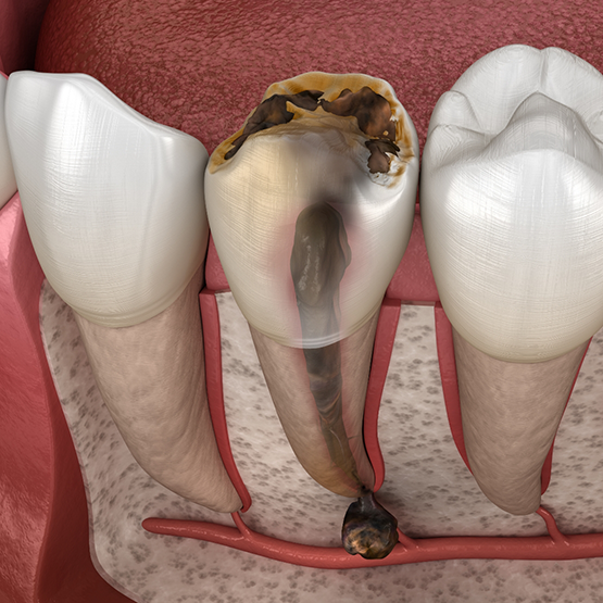 Illustration of a severely decayed and damaged tooth
