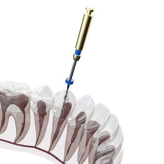 Illustration of a thin dental instrument treating the inside of a tooth