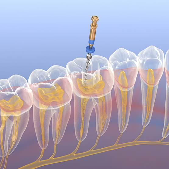 Illustration of a thin dental instrument performing root canal treatment on a tooth