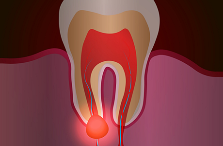 Illustration of a tooth with a bump on the gums near its root