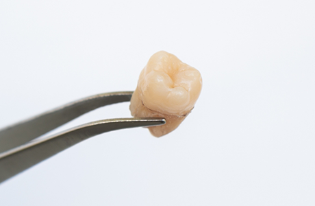 Tweezers holding an extracted tooth