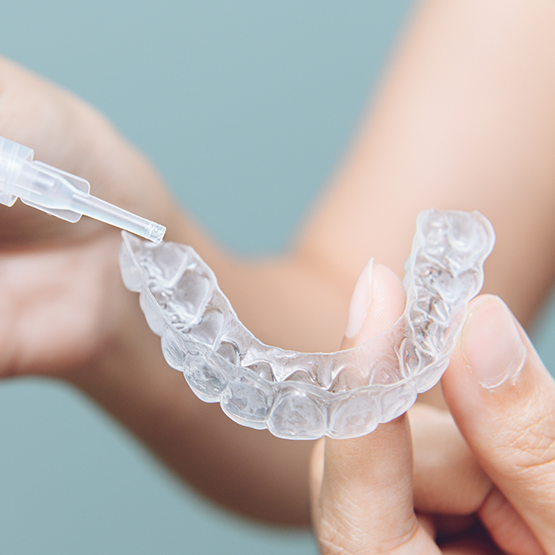 Person filling a teeth whitening tray with bleaching gel