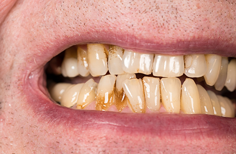 Close up of a smile with severely discolored teeth