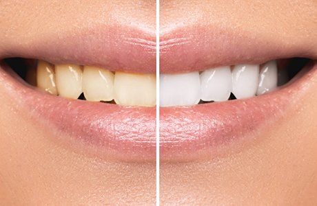 Close up of a smile before and after teeth whitening
