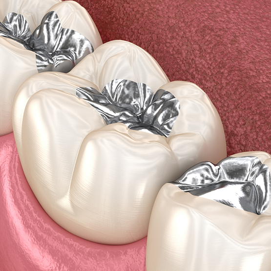 Illustration of several teeth with gray metal fillings
