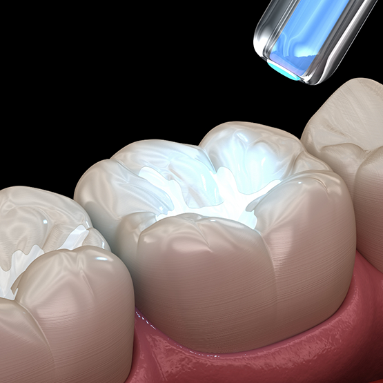 Illustration of an ultraviolet light being shone onto a tooth with a white filling