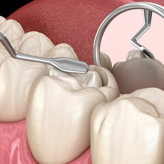 Illustration of a composite filling being placed in a tooth