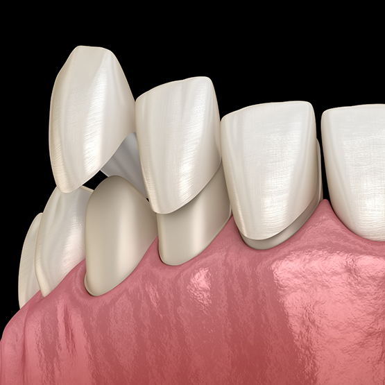 Illustration of veneers being placed over the front surfaces of teeth