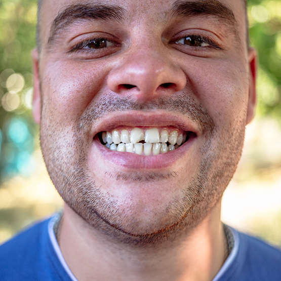 Close up of a man smiling with a chipped front tooth