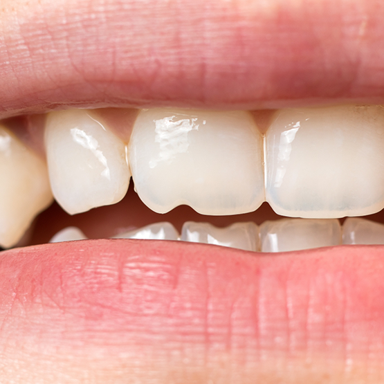 Close up of a mouth with a chipped front tooth
