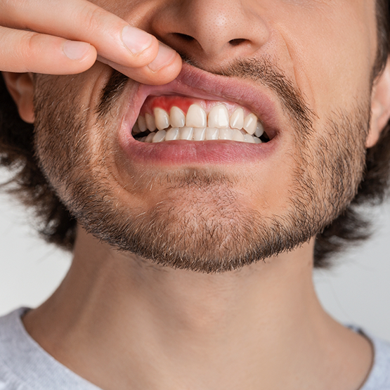 Close up of a man poinitng to his red gums