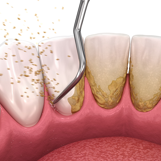 Illustration of a dental scaler clearing tartar buildup from the teeth and gumline