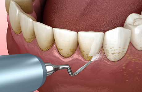 Illustrated dental scaler removing tartar buildup from the teeth and gums