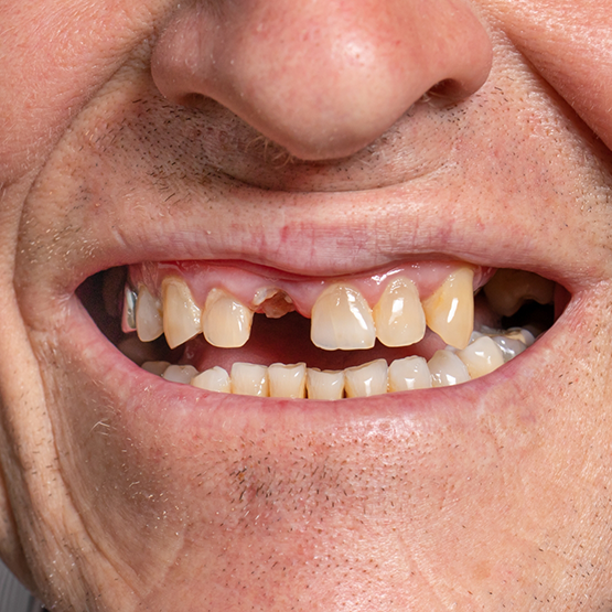 Close up of a smile with several missing teeth