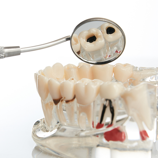 Dental mirror reflecting a model of a decayed tooth