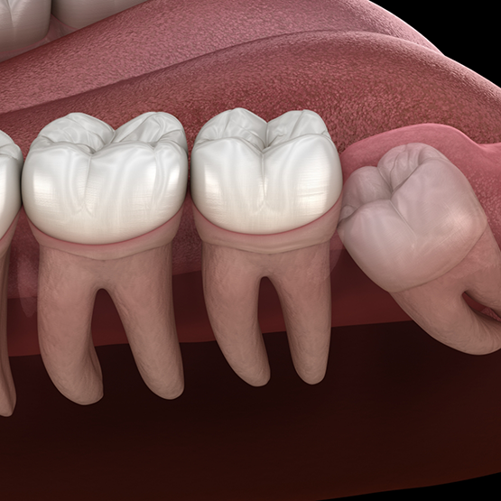 Illustration of an impacted wisdom tooth pressing against the adjacent tooth