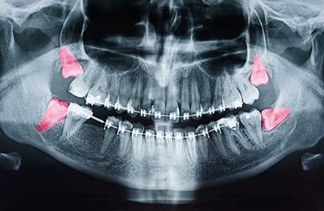 X ray of the teeth with all four wisdom teeth highlighted red
