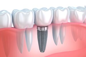 3D rendering of a dental implant between several other teeth